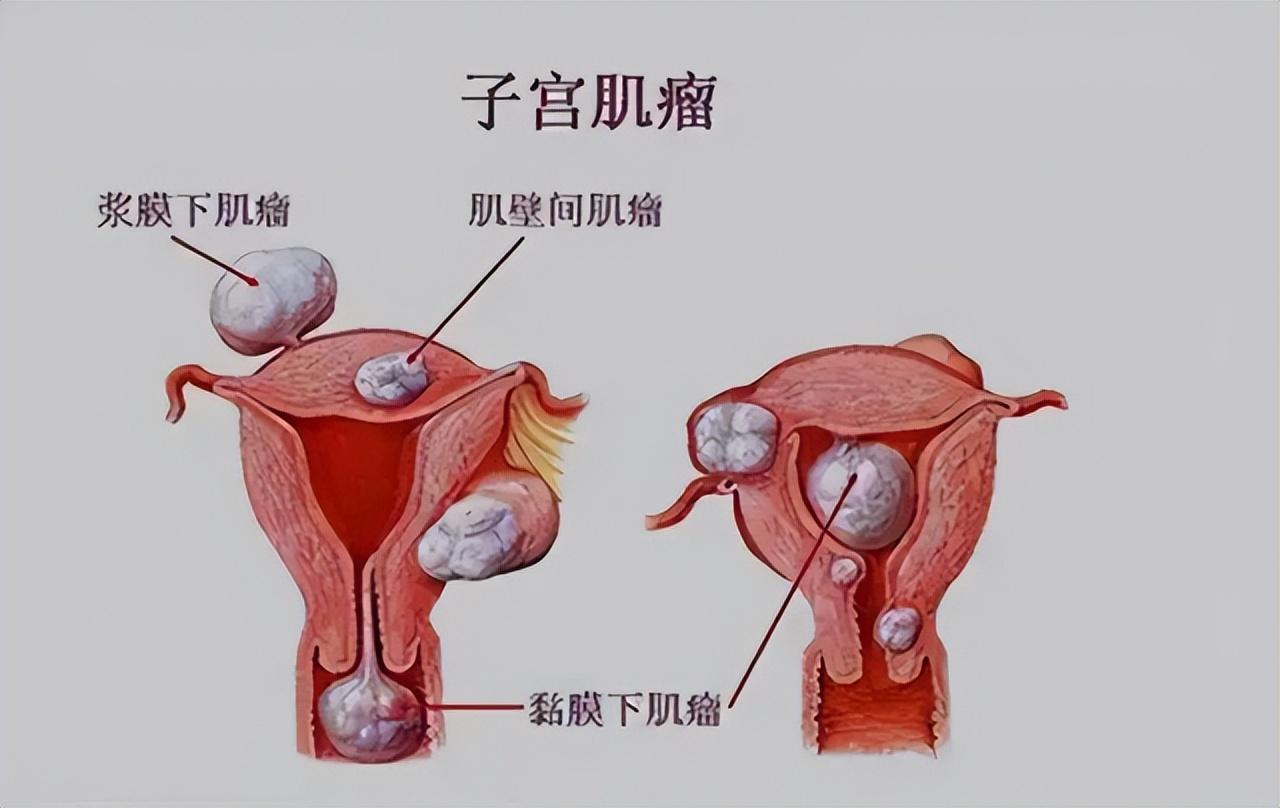 中医治疗子宫腺肌瘤_怎样治疗子宫腺肌瘤_子宫肌瘤过大中医治疗吗