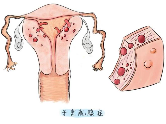 子宫阔韧带肌瘤治疗_子宫肌瘤过大中医治疗吗_子宫长小肌瘤怎么治疗