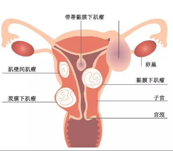 子宫多发肌瘤是什么_中医治疗多发子宫肌瘤_子宫多发肌瘤是什么意思