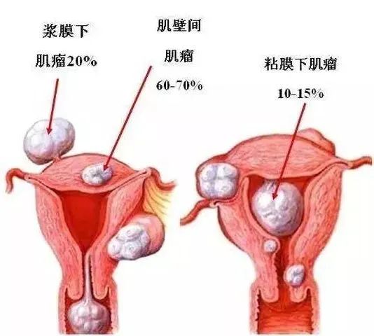 中医治疗多发子宫肌瘤_子宫多发肌瘤要吃药吗_子宫多发肌瘤