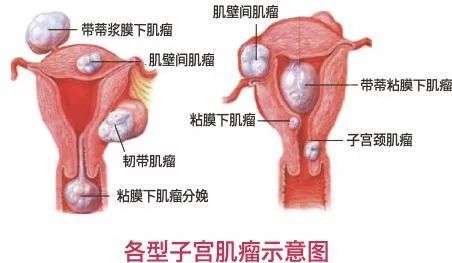 子宫多发肌瘤要吃药吗_中医治疗多发子宫肌瘤_子宫多发肌瘤